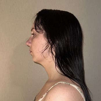 Zannis Plastic Surgery - Before - Plastic Surgeons Near Me - New Bern, North Carolina
