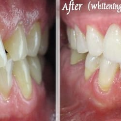 Smile transformation_2