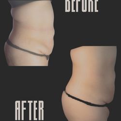 BayAreaVibe Body Sculpting & Post Op Care - RF Therapy:Skin tightening