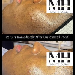 Milk & Honey Beauty Lounge - Microdermabrasion (Exfoliation that buffs away dead skin cells, revealing a even tone and youthful glow) Before & After