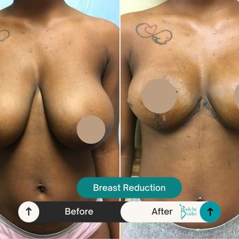 Timothy Bradley, MD - Before & After Breast Reduction 1 week - Cosmetic Surgeons Near Me - Tamarac, Florida Timothy Bradley, MD - Before & After Breast Reduction 1 week - Cosmetic Surgeons Near Me - Tamarac, Florida