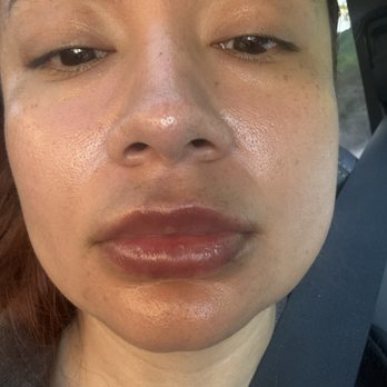 NakedMD - A day and a half after one syringe of dissolver. - Medical Spas Near Me - Downey, California NakedMD - A day and a half after one syringe of dissolver. - Medical Spas Near Me - Downey, California