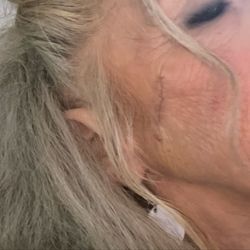 Hodari MD Dermatology & Rejuvené - Healing nicely! Used the ointment Dr. Hodari gave me. Looking good!