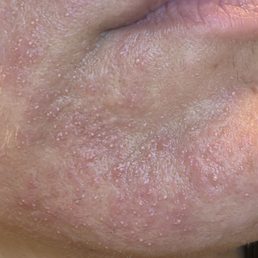 3 days post treatment, my skin is so upset! 3 days post treatment, my skin is so upset!