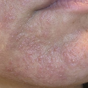 TROIAREUKE California - 3 days post treatment, my skin is so upset! - Skin Care Near Me - Buena Park, California