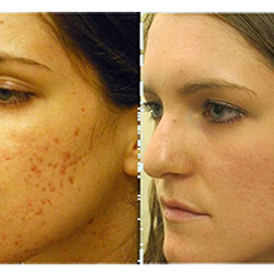 Laser Aesthetic Center - Laser for Acne Scars