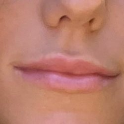 Hamilton Facial Plastic Surgery - Half a syringe
