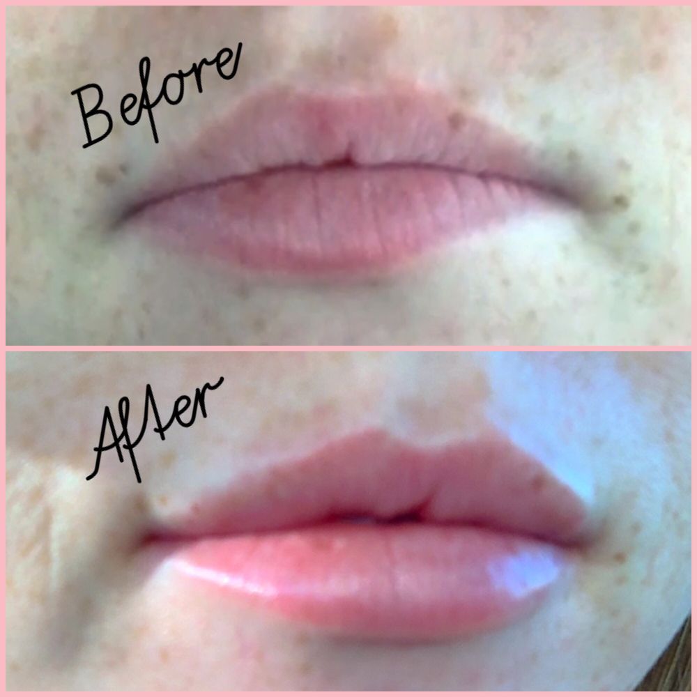 Plush Med Spa - Juvederm Ultra - Medical Spas Near Me - Camarillo, California Plush Med Spa - Juvederm Ultra - Medical Spas Near Me - Camarillo, California