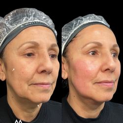 Modern Aesthetics & Wellness - ILaser 1940 with Dr. Anwar