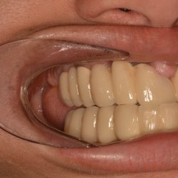 National Dental Bronx - If you think this looks good, then roll the dice at American Dental cause they consider this "GREAT WORK" My lawyer calls it MALPRACTICE
