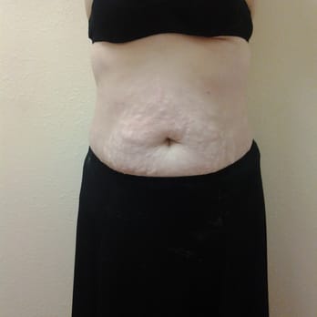 Face and Body Solutions by Beth - After 6 cavi-lipo treatments - Skin Care Near Me - Lady Lake, Florida Face and Body Solutions by Beth - After 6 cavi-lipo treatments - Skin Care Near Me - Lady Lake, Florida