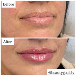 Beauty Goals LV - Lip filler