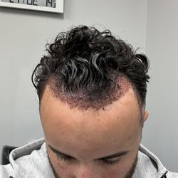 Anderson Center for Hair - After procedure