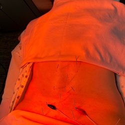 Sunyo Acupuncture Center - Back acupuncture with electrical stimulation.