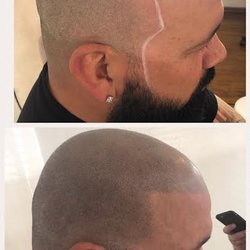 DreaM Aesthetics - Scalp Micro Pigmentation