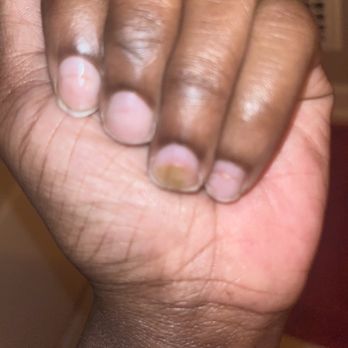 Nailtique Studio - Fungal infection - Nail Salons Near Me - Pittsburgh, Pennsylvania Nailtique Studio - Fungal infection - Nail Salons Near Me - Pittsburgh, Pennsylvania