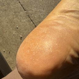 bottom of my feet IMMEDIATELY after my appointment