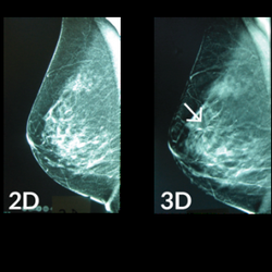 Premier Women's Radiology - The difference is clear between a regular 2D mammogram and 3D mammogram. Call today and schedule your annual screening.