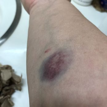 Quest Diagnostics - 1 hr after getting blood drawn. - Laboratory Testing Near Me - Fremont, California Quest Diagnostics - 1 hr after getting blood drawn. - Laboratory Testing Near Me - Fremont, California