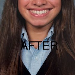 Chang Orthodontics - Perfectly positioned teeth thanks to Dr. Chang and Invisalign. He achieved this smile with no extractions of permanent adult teeth.