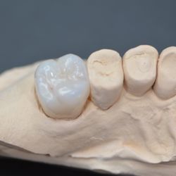 Final Cut Dental Milling Center - Molar crown upper