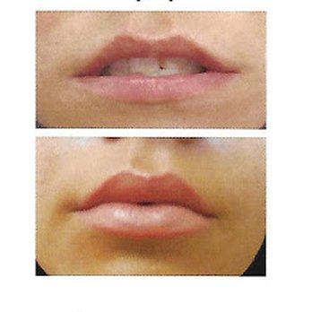 Lorelle Kramer, MD - Beautiful, Full Lips. B&A- Lip Filler - Cosmetic Surgeons Near Me - Wauwatosa, Wisconsin