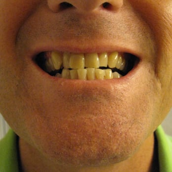 La Mesa Dental - Before - General Dentistry Near Me - La Mesa, California