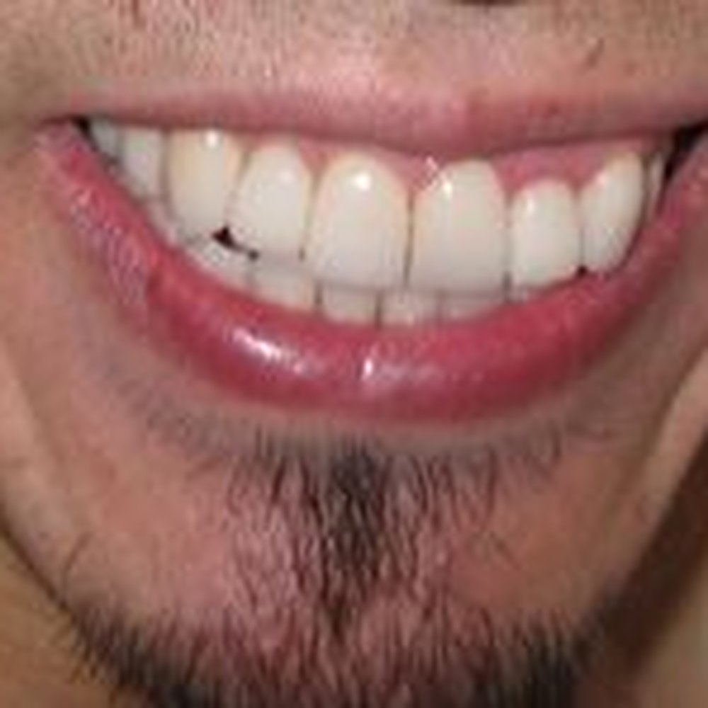 My now perfect, straight teeth thanks to Dr. Stephen G! My now perfect, straight teeth thanks to Dr. Stephen G!