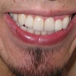 My now perfect, straight teeth thanks to Dr. Stephen G!