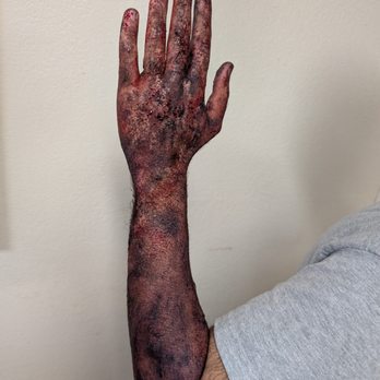 I Make Faces - burnt bloody arm- effects makeup by Diana Tenes / I Make Faces - Makeup Artists Near Me - Benicia, California I Make Faces - burnt bloody arm- effects makeup by Diana Tenes / I Make Faces - Makeup Artists Near Me - Benicia, California