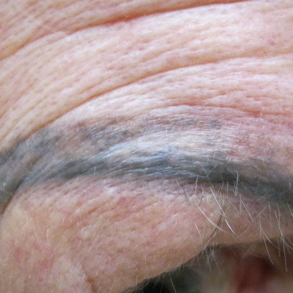 Removery Tattoo Removal & Fading - Example of one eye. Blotchy mess with many different colors after Removery treatments! - Tattoo Removal Near Me - Knoxville, Tennessee Removery Tattoo Removal & Fading - Example of one eye. Blotchy mess with many different colors after Removery treatments! - Tattoo Removal Near Me - Knoxville, Tennessee