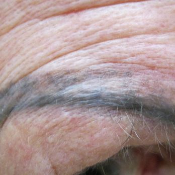 Removery Tattoo Removal & Fading - Example of one eye. Blotchy mess with many different colors after Removery treatments! - Tattoo Removal Near Me - Knoxville, Tennessee