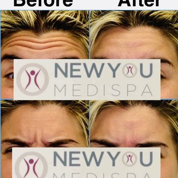 New You Medispa - Botox treatment to the forehead and 11's. www.newyoumedispa.com - Medical Spas Near Me - Howell, New Jersey New You Medispa - Botox treatment to the forehead and 11's. www.newyoumedispa.com - Medical Spas Near Me - Howell, New Jersey