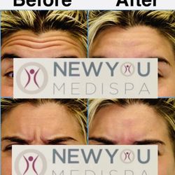 New You Medispa - Botox treatment to the forehead and 11's.  www.newyoumedispa.com