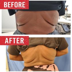 Body contouring treatment before and after.