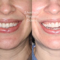Dentalvana - Following the golden rules of proportions, neighboring teeth, and the overall smile curtain is what creates a truly natural smile. 2 teeth.