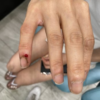 JoJo Nails - Day of incident, blood subsided a bit, not sure why it's normal to push cuticles back this hard. - Nail Salons Near Me - Chino, California JoJo Nails - Day of incident, blood subsided a bit, not sure why it's normal to push cuticles back this hard. - Nail Salons Near Me - Chino, California