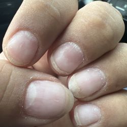 Marisa Nail & Spa - Orange spot on thumb and ring finger (side), damaged nail beds and cuticles, crooked nails.