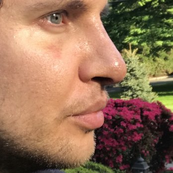 William D Losquadro, MD - 1 week post surgery with Dr L - Cosmetic Surgeons Near Me - Katonah, New York William D Losquadro, MD - 1 week post surgery with Dr L - Cosmetic Surgeons Near Me - Katonah, New York