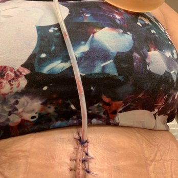 Festus B Dada, MD JD - After a month of swelling the doctor finally inserts a drain. - Surgeons Near Me - Murrieta, California