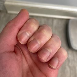 Posh Spa & Nails - This is about a month of getting my nails removed. Notice the damage still.