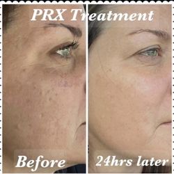 Dayle's European Skincare & Med Spa - PRX Derm Perfexion is NOT A Peel. PRX Derm Perfexion is a Chemical Collagen Stimulator.