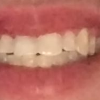 Bella Dental Services - After picture - General Dentistry Near Me - La Puente, California Bella Dental Services - After picture - General Dentistry Near Me - La Puente, California