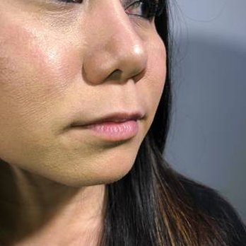 Ageless MD - Pre-Juverderm Ultra XC fillers...my lips were so small! - Medical Spas Near Me - Tustin, California