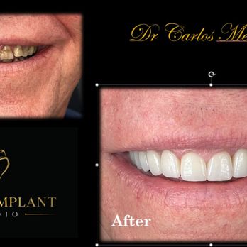 Dental Implant Studio - Miami Lakes - Before and after Smile Design - General Dentistry Near Me - Miami Lakes, Florida Dental Implant Studio - Miami Lakes - Before and after Smile Design - General Dentistry Near Me - Miami Lakes, Florida