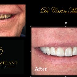 Dental Implant Studio - Miami Lakes - Before and after Smile Design
