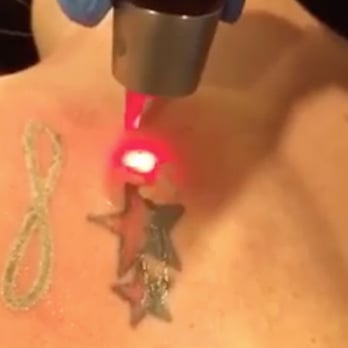VIP Tattoo Removal - Las Vegas - Picosure tattoo removal. - Tattoo Removal Near Me - Henderson, Nevada VIP Tattoo Removal - Las Vegas - Picosure tattoo removal. - Tattoo Removal Near Me - Henderson, Nevada