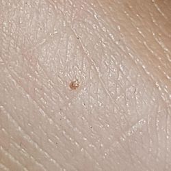Gateway Dermatology - Mites from my mind 1