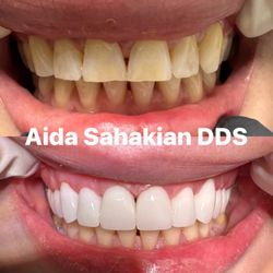 Aida Sahakian, DDS - Upper 14 zirconium crown