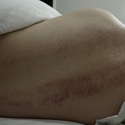 Bruising from the massage parlor Bruising from the massage parlor